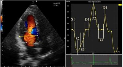 Evaluation of left ventricular flow field changes after stress in patients with nonobstructive coronary artery disease using ultrasonic flow vector imaging